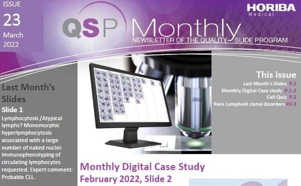 HORIBA Medical QSP Newsletter #23 - Acute myeloid leukemia HORIBA Medical QSP Newsletter #23 - Acute myeloid leukemia