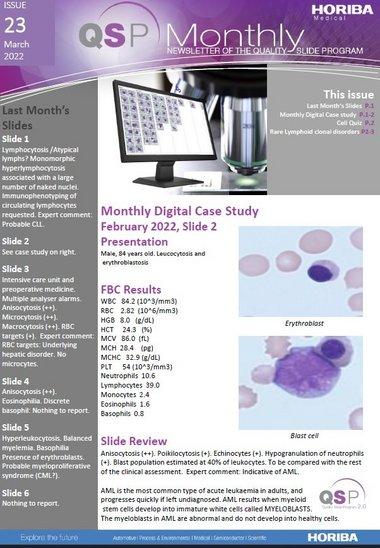 HORIBA Medical QSP Newsletter #23 - Acute myeloid leukemia HORIBA Medical QSP Newsletter #23 - Acute myeloid leukemia