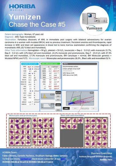 HORIBA Medical Chase the Case #5 (EN) - Acute myeloid leukemia type monoblastic (AML-M5b) HORIBA Medical Chase the Case #5 (EN) - Acute myeloid leukemia type monoblastic (AML-M5b)