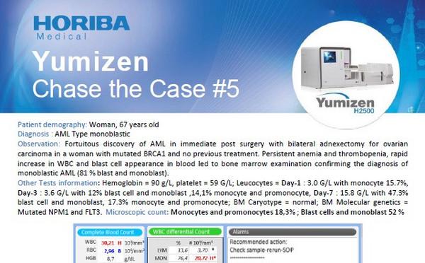 HORIBA Medical Chase the Case #5 (EN) - Acute myeloid leukemia type monoblastic (AML-M5b) HORIBA Medical Chase the Case #5 (EN) - Acute myeloid leukemia type monoblastic (AML-M5b)