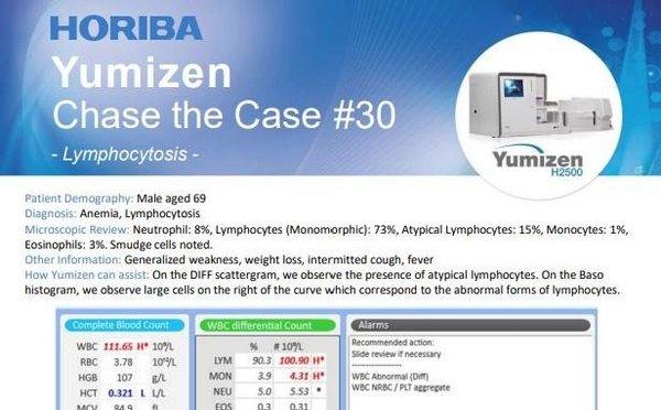 HORIBA Chase the Case #30 - Lymphocytosis HORIBA Chase the Case #30 - Lymphocytosis