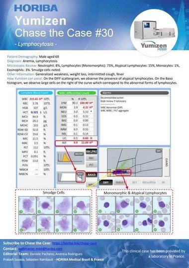 HORIBA Chase the Case #30 - Lymphocytosis HORIBA Chase the Case #30 - Lymphocytosis