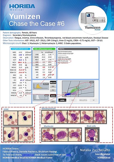 HORIBA Medical Chase the Case #6 (EN) - Secondary Myelodysplasia HORIBA Medical Chase the Case #6 (EN) - Secondary Myelodysplasia