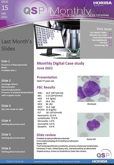 HORIBA Medical QSP Newsletter #15 - Paroxysmal Nocturnal Haemoglobinuria (PNH)
