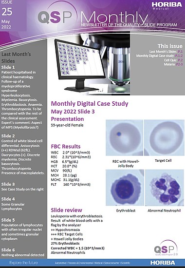 HORIBA Medical QSP Newsletter #25 - Leukopenia HORIBA Medical QSP Newsletter #25 - Leukopenia