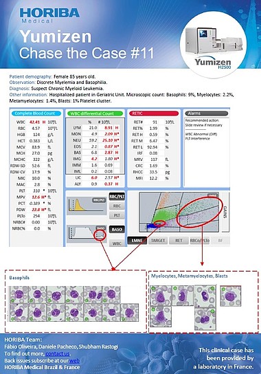 HORIBA Medical Chase the Case #11 (EN) - Suspected Chronic Myeloid Leukemia HORIBA Medical Chase the Case #11 (EN) - Suspected Chronic Myeloid Leukemia