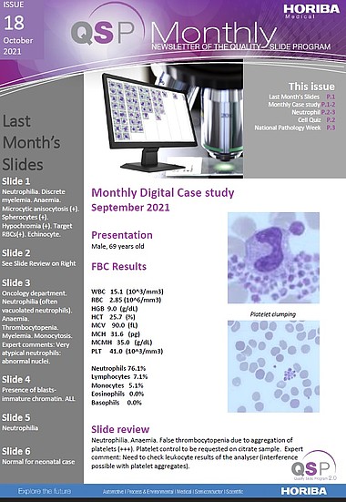 HORIBA Medical QSP Newsletter #18 - Neutrophilia and platelet aggregation HORIBA Medical QSP Newsletter #18 - Neutrophilia and platelet aggregation