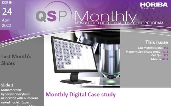 HORIBA Medical QSP Newsletter #24 - Hyperleukocytosis HORIBA Medical QSP Newsletter #24 - Hyperleukocytosis