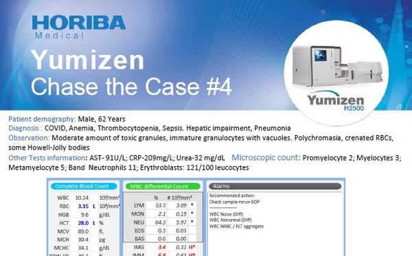 HORIBA Medical Chase the Case #4 (EN) - Sepsis and COVID HORIBA Medical Chase the Case #4 (EN) - Sepsis and COVID