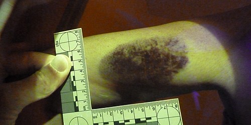 Bruises, Bite Marks and Pattern Wounds