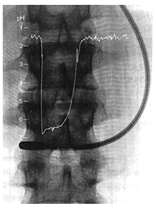 Electrodes in the Stomach