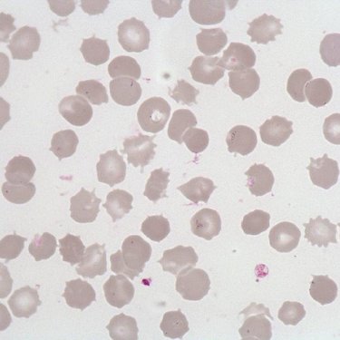 Acanthocyte