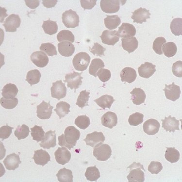 Acanthocyte