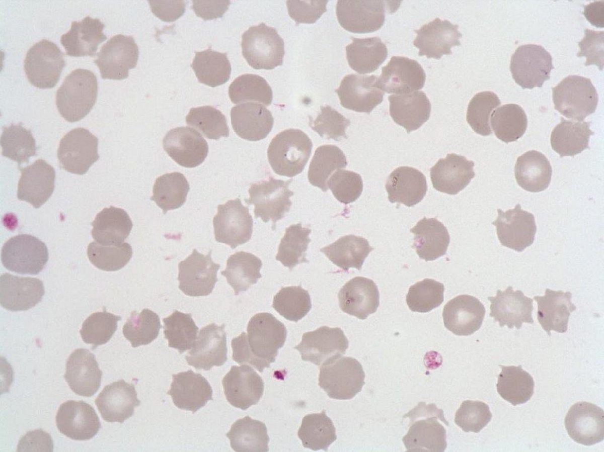 Acanthocyte