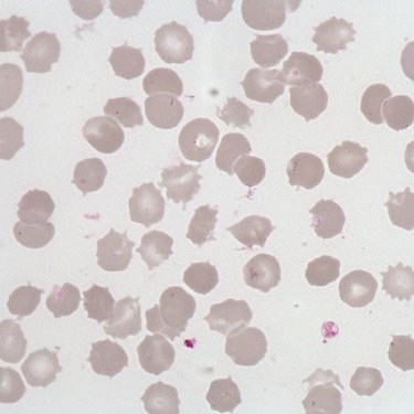 Acanthocyte
