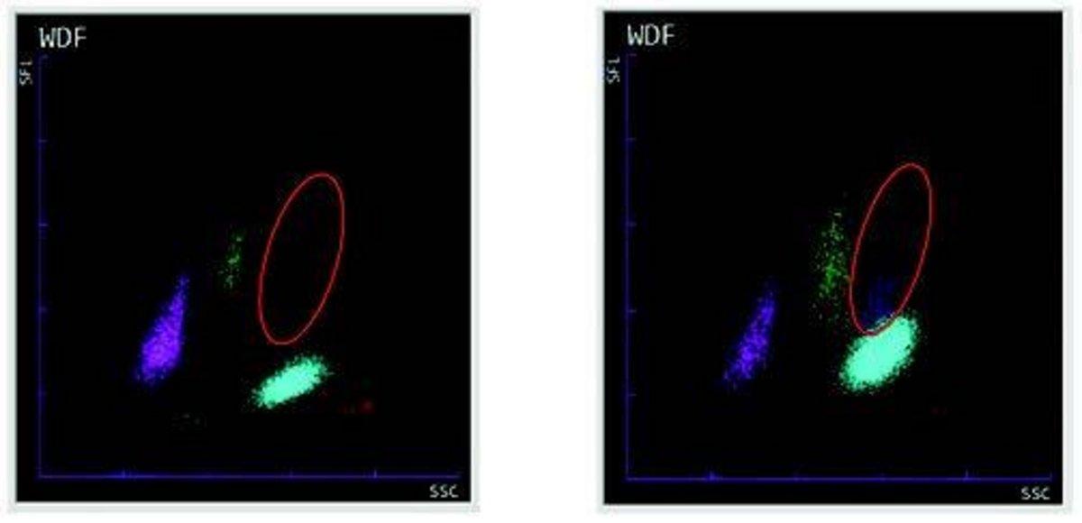 Figure 3: Low IG (left) vs high IG (right) from Sysmex XN-3000 WDF matrix