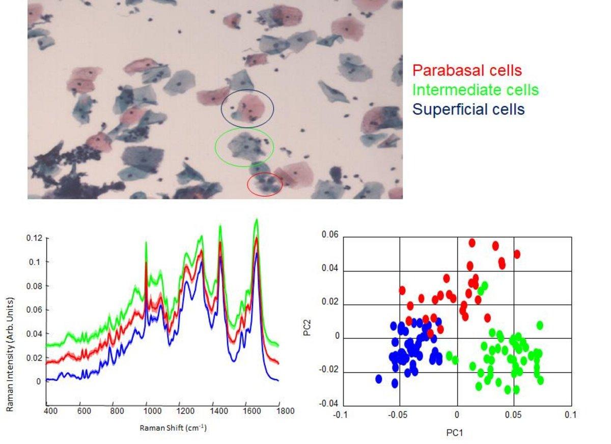 Figure 2: Raman spectra and Principal Components Analysis plot showing discrimination between superficial (blue), intermediate (green) and parabasal (red) cervical cells.
