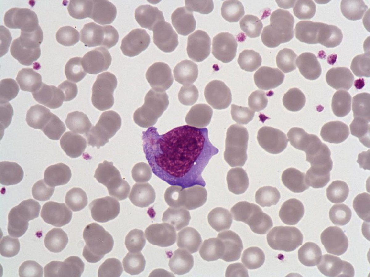 Hyperbasophilic_lymphocyte Hyperbasophilic_lymphocyte