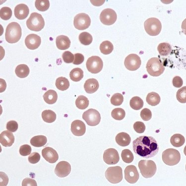 Microcytosis