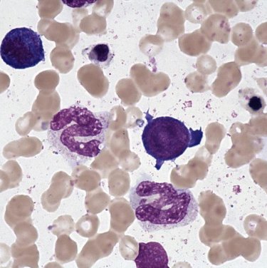 Giant_metamyelocyte__Vitamin_deficiency_