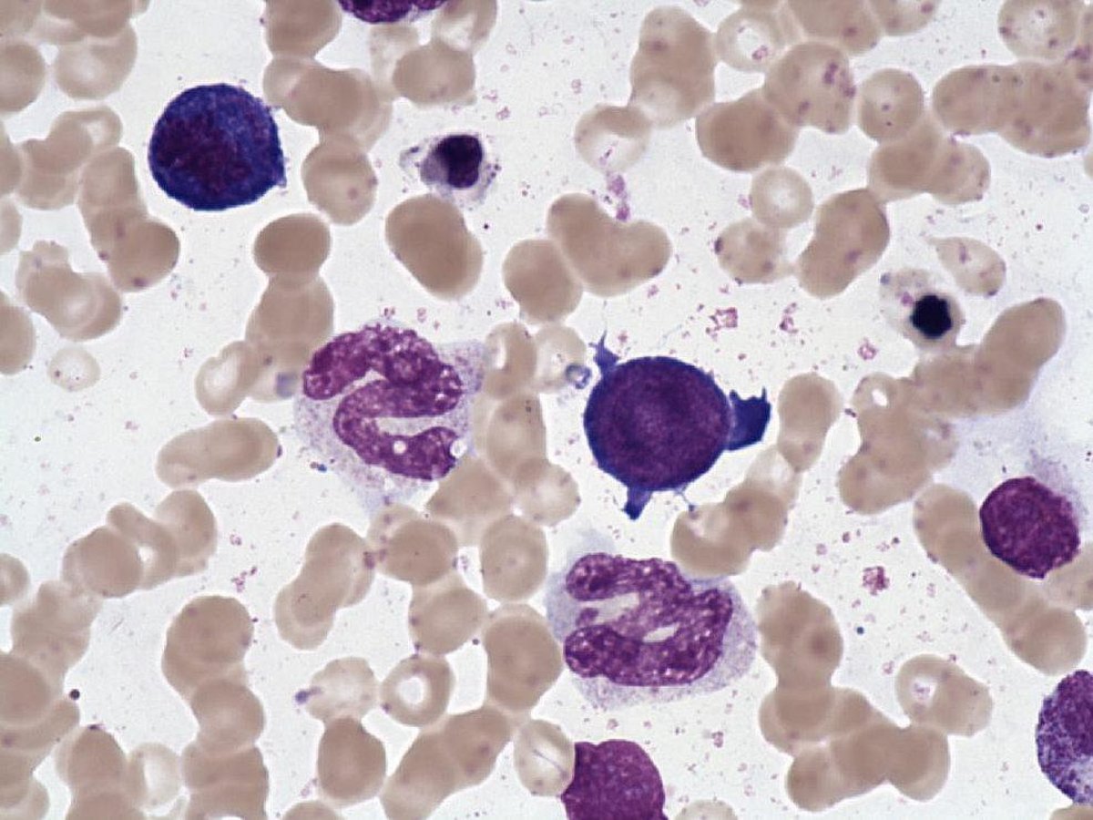 Giant_metamyelocyte__Vitamin_deficiency_ Giant_metamyelocyte__Vitamin_deficiency_