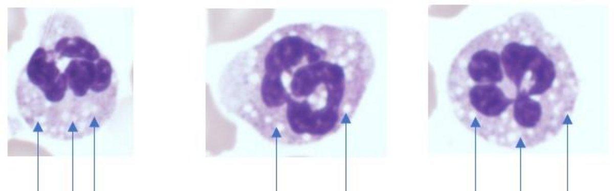 Vacuolated Neutrophils