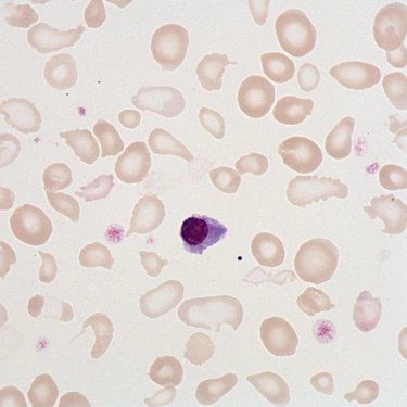 Poikilocytosis