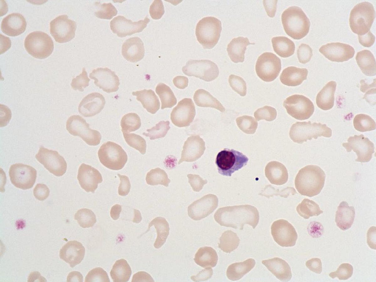 Poikilocytosis