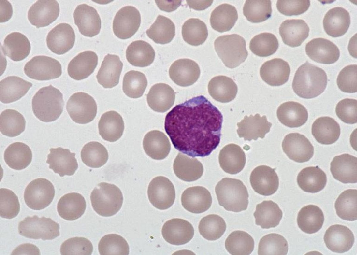 Mantle_lymphoma_lymphocytes Mantle_lymphoma_lymphocytes