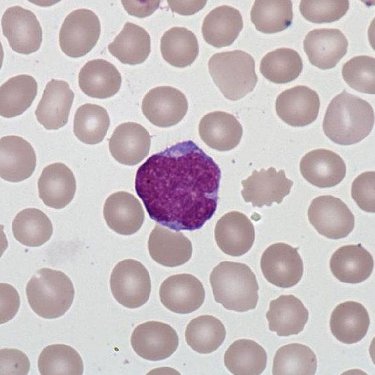 Mantle_lymphoma_lymphocytes