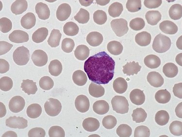 Mantle_lymphoma_lymphocytes