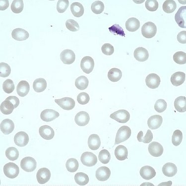 Tear_drop_cell__dacryocyte_