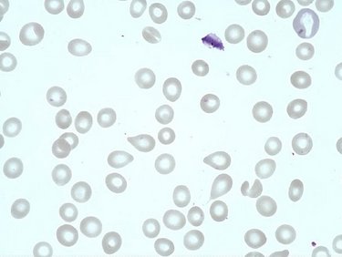 Tear_drop_cell__dacryocyte_