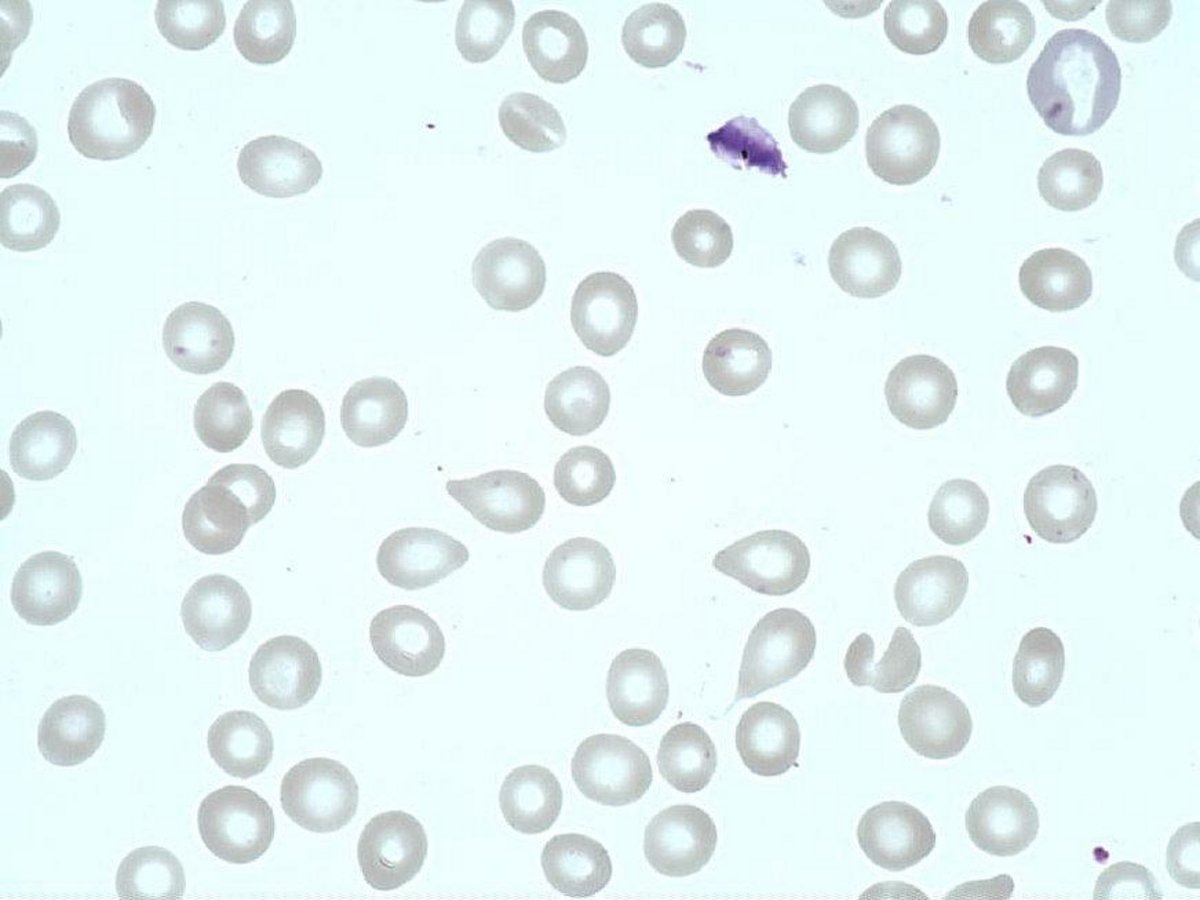 Tear_drop_cell__dacryocyte_