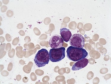 Erythroblast_of_megaloblastic_anemia