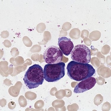 Erythroblast_of_megaloblastic_anemia