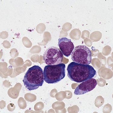 Erythroblast_of_megaloblastic_anemia