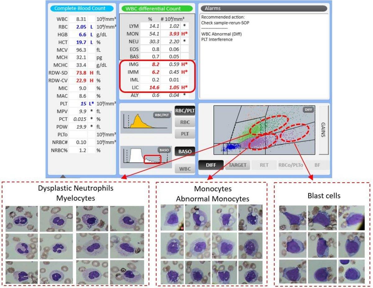 Yumi Hashibaページ Sickle Cell Anemia Clinical Case - HORIBA Chase the Case #38