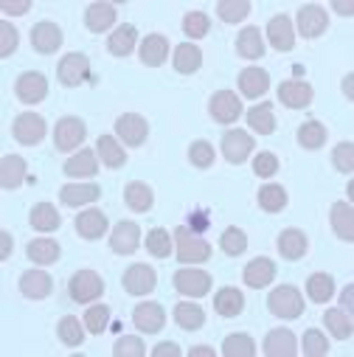 Anemia - QSP Blood Cell Morphology Newsletter #40 (HORIBA Medical)