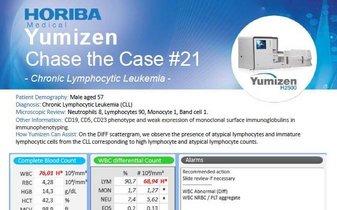 HORIBA医疗追逐# 21 -慢性淋巴细胞白血病