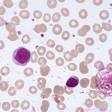 Prolymphocyte