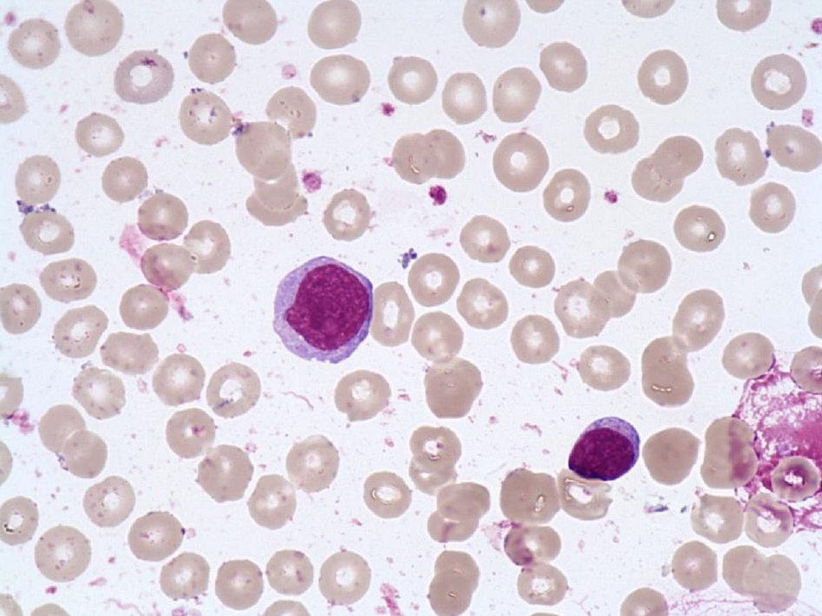 Prolymphocyte