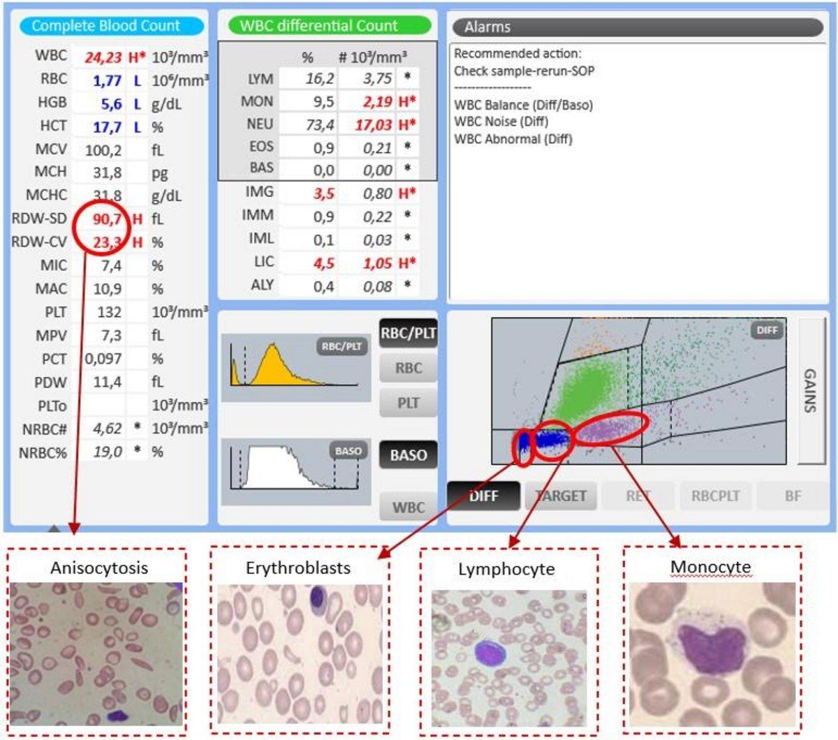 Clinical Case 19 - Sickle cell anemia - HORIBA