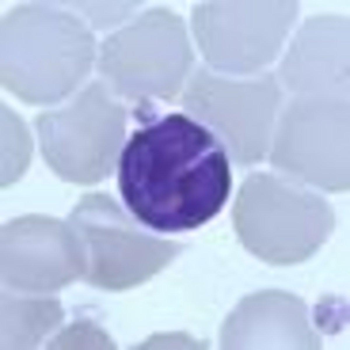 Abnormal lymphocyte