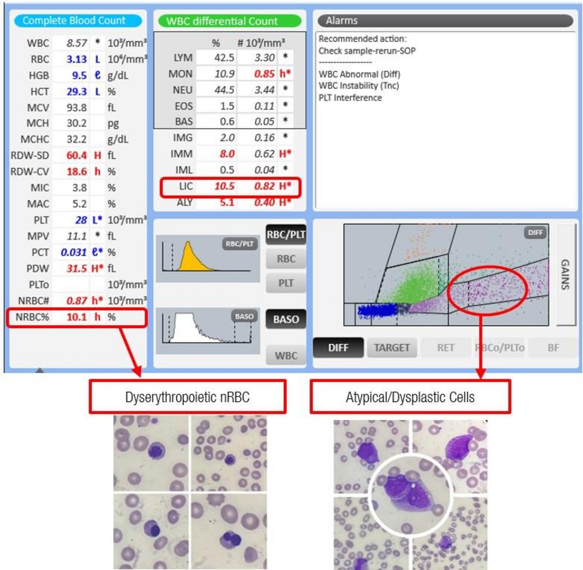 Yumi Hashibaページ Metastatic Bone Marrow Infiltration (Clinial Case) | HORIBA