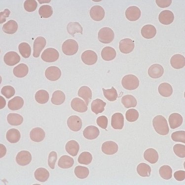 Schistocyte