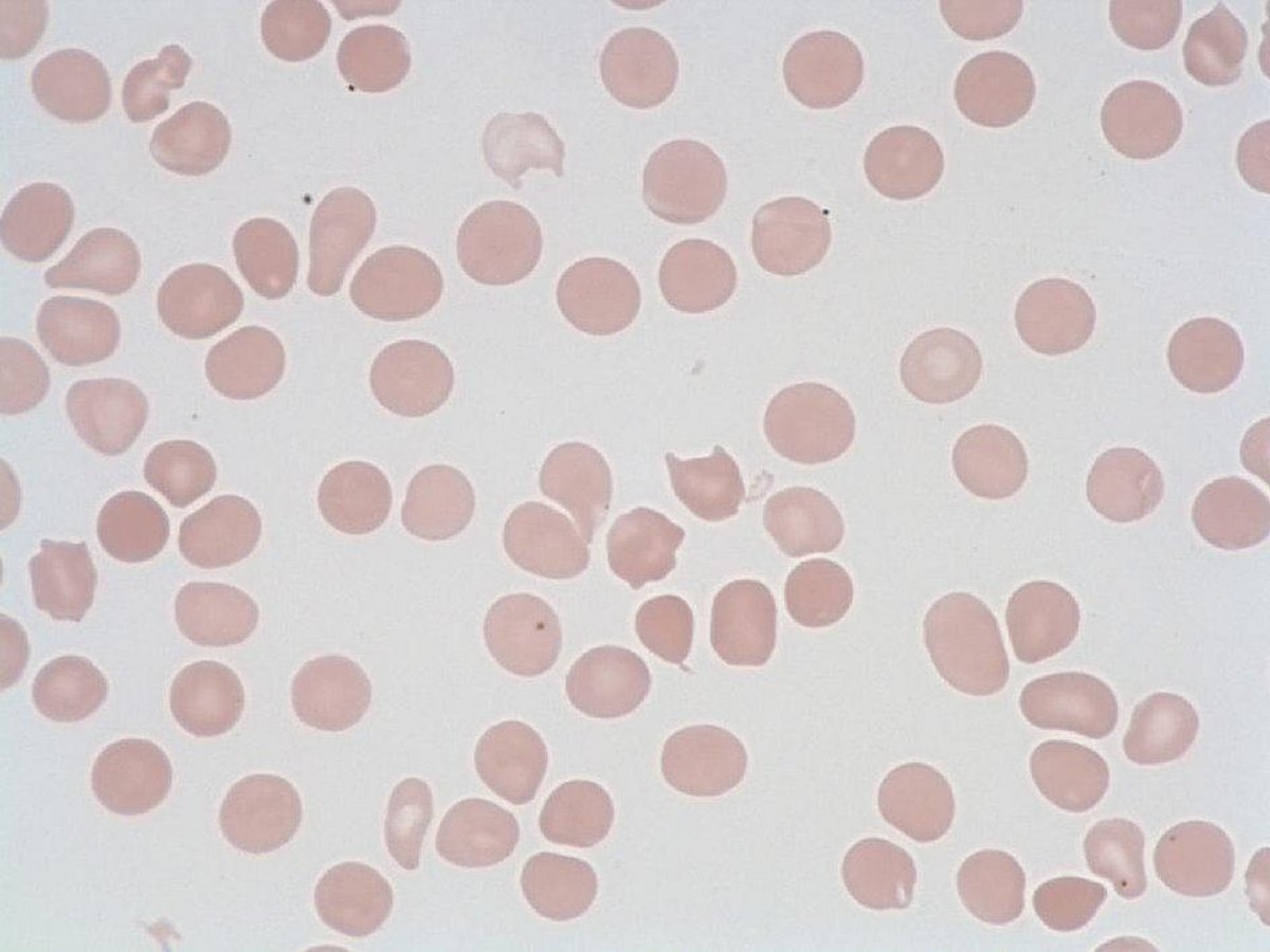 Schistocyte - HORIBA