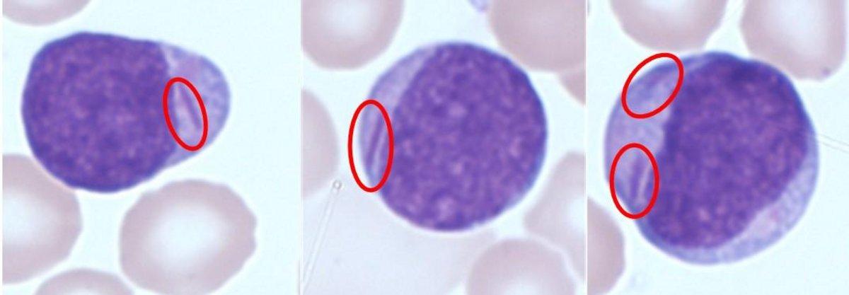 Yumi Hashibaページ Heme Insights 1 - HORIBA Hematology Newsletter