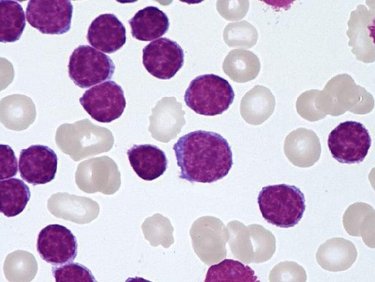 CLL_lymphocytes