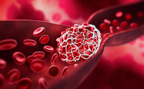 thrombosis-blood_clots